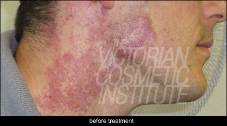 birthmark removal before treatment