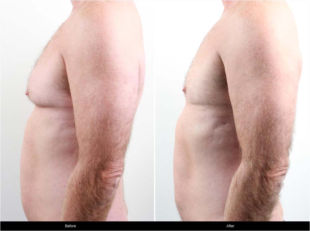 Gynaecomastia (man boobs) Before and After Case Study 1