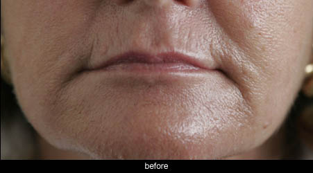 before non surgical jowl reduction