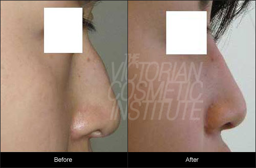 Non Surgical Nose Shaping