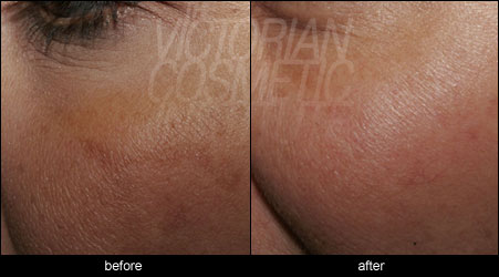 melasma melbourne