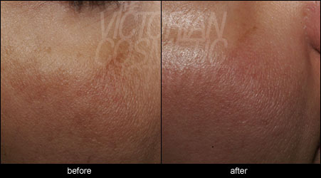 skin pigment melasma