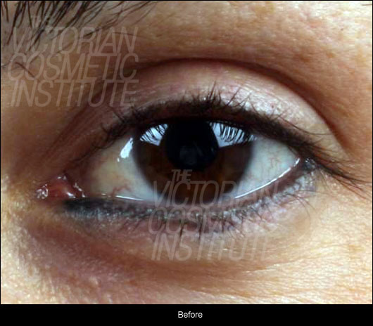 cosmetic tattoo before