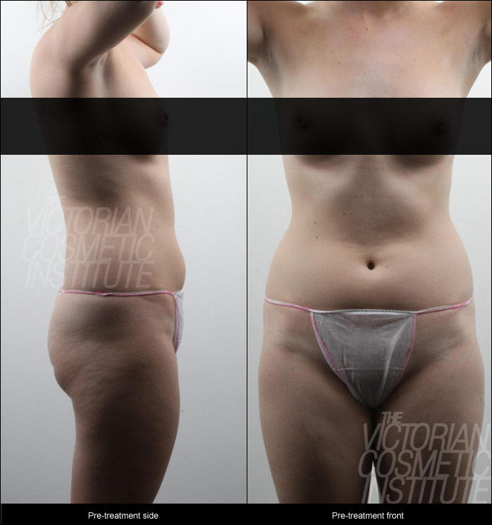 before liposuction