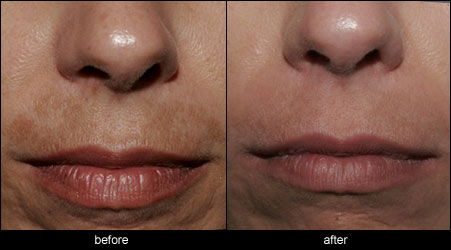 melasma pigmentation treatment