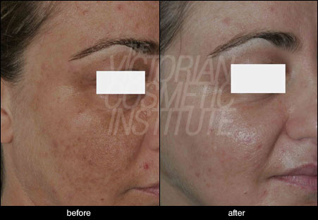 skin pigmentation before and after