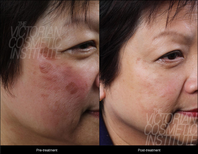 pigmentation before and after