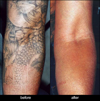 tattoo removal before after arm