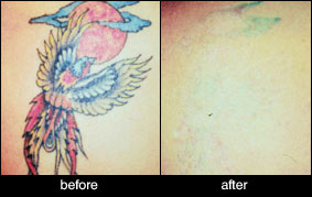 Laser Tattoo Removal – Before and After Gallery - Victorian Cosmetic  Institute