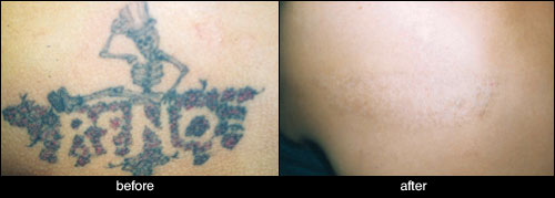 before after tattoo removal