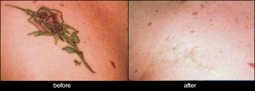 tattoo removal before after