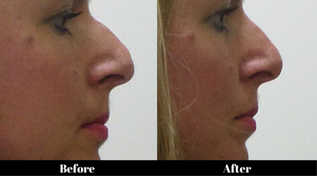 Dermal filler for non-surgical rhinoplasty