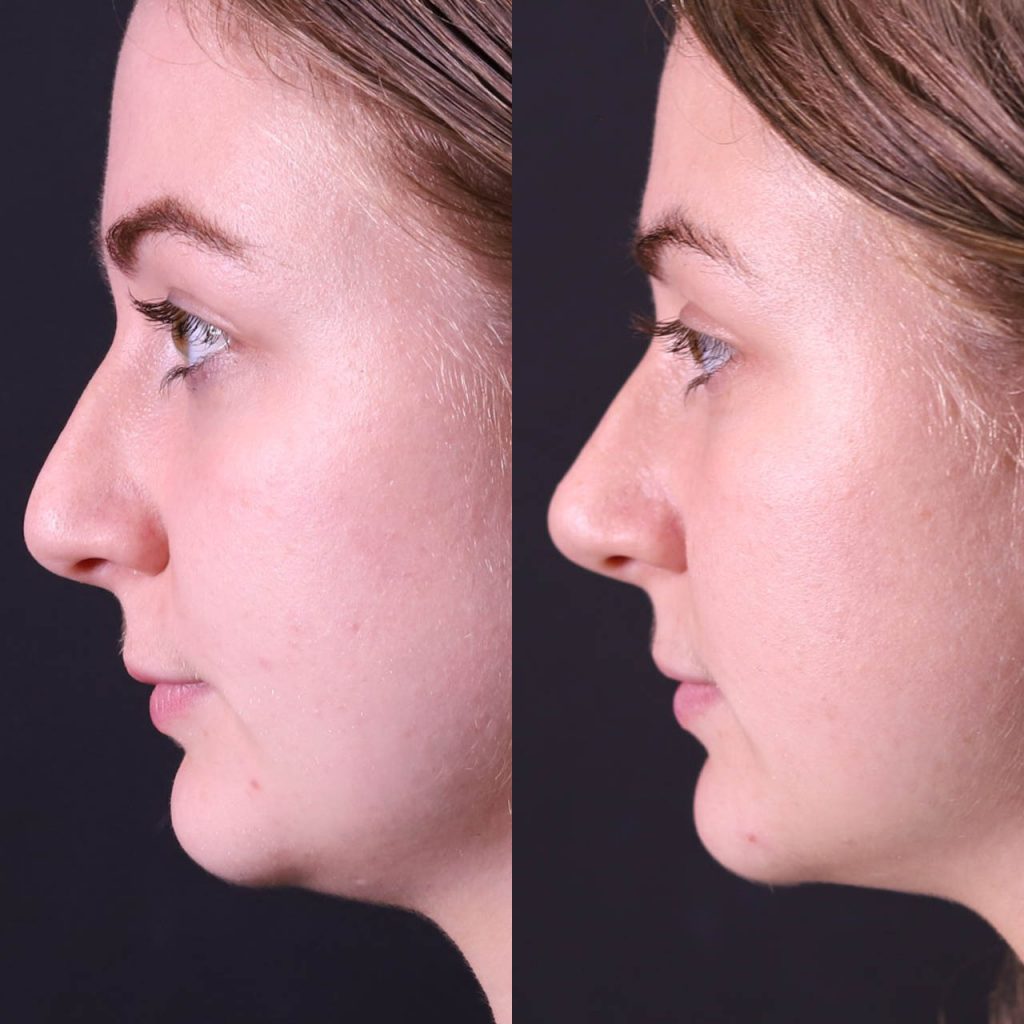 nose filler before and after
