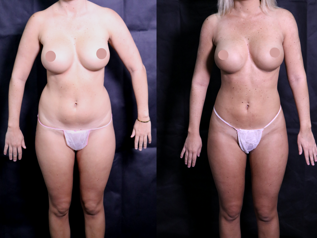 before and after liposuction 