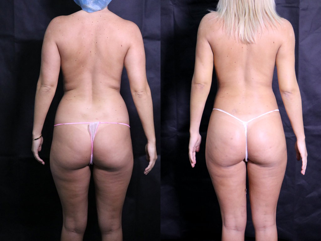 before and after liposuction melbourne