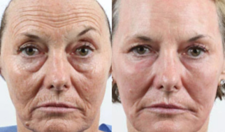 My Journey with CO2 Laser Resurfacing
