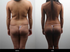 liposuction brazilian butt lift