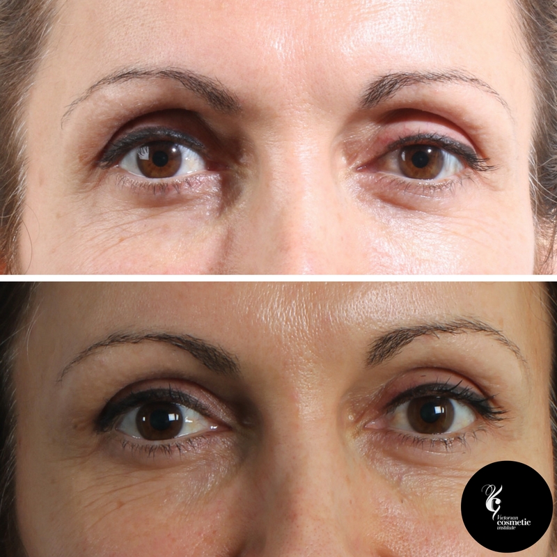 how to get rid of droopy eyelids after botox