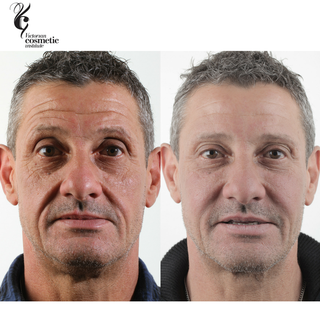 Male Rejuvenation Melbourne. Victorian Cosmetic Institute