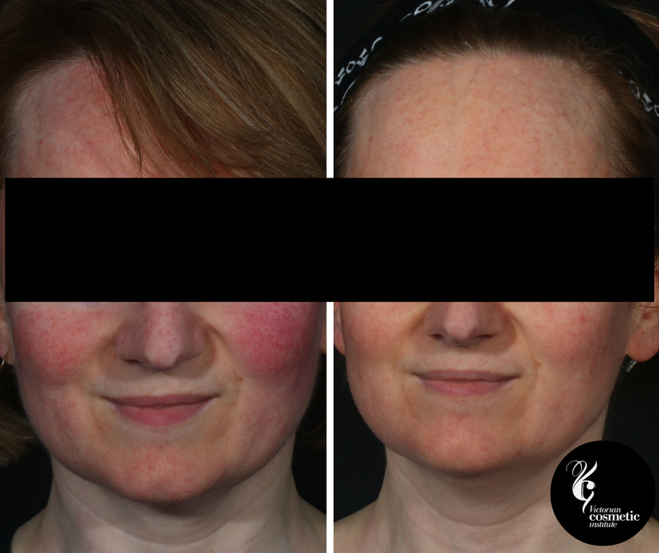 rosacea with led light therapy