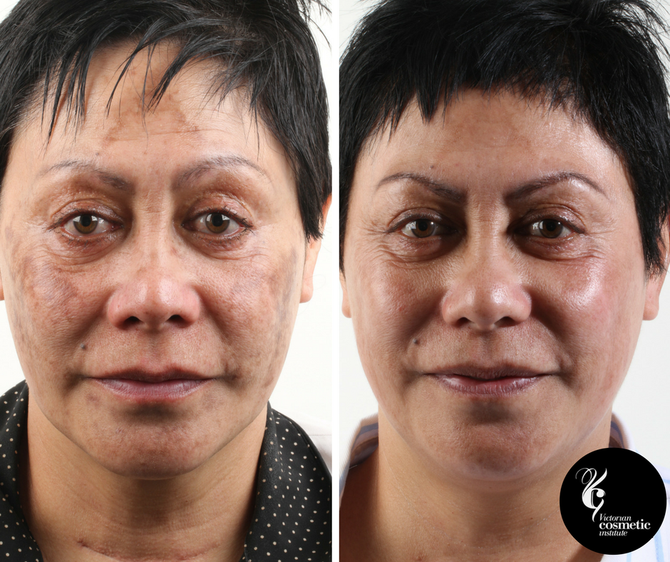 Get Reliable Melasma Treatment In Australia From The VCI