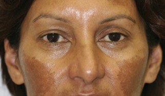 melasma pigmentation