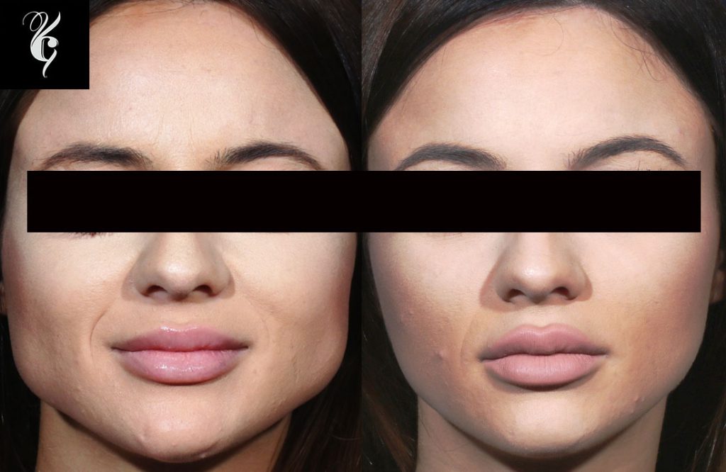 masseter botox jawline slimming melbourne