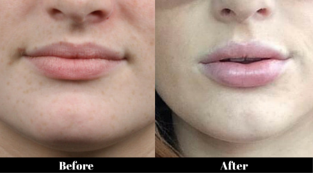 lip fillers