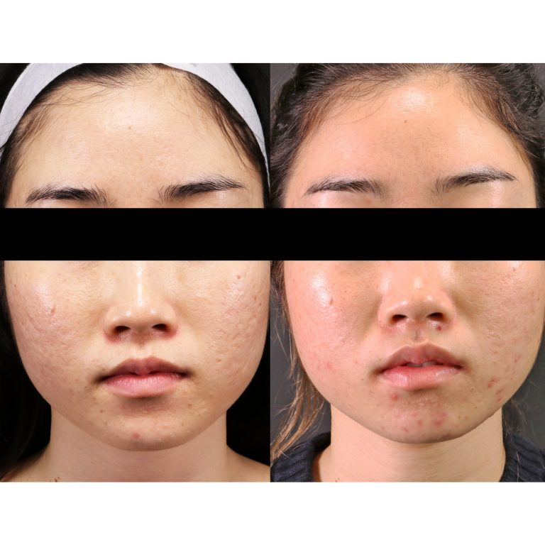 Acne Scarring Treatment Melbourne Victorian Cosmetic Institute