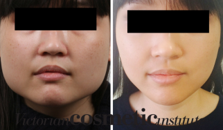 jawline slimming with botox before and after