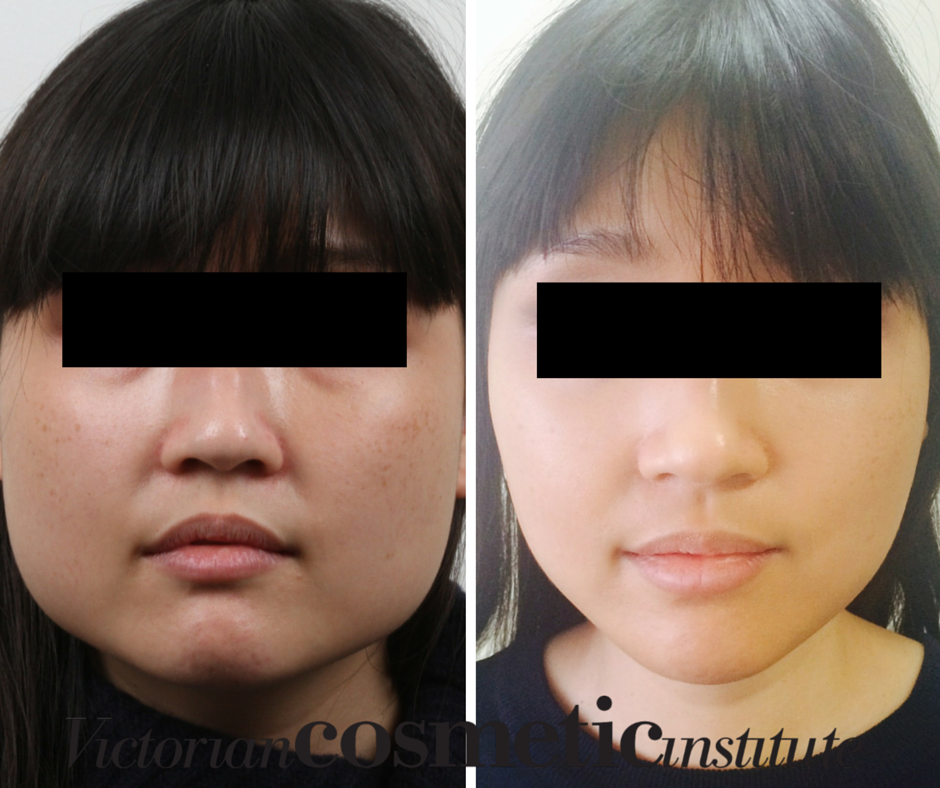 face slimming surgery before and after 0 4