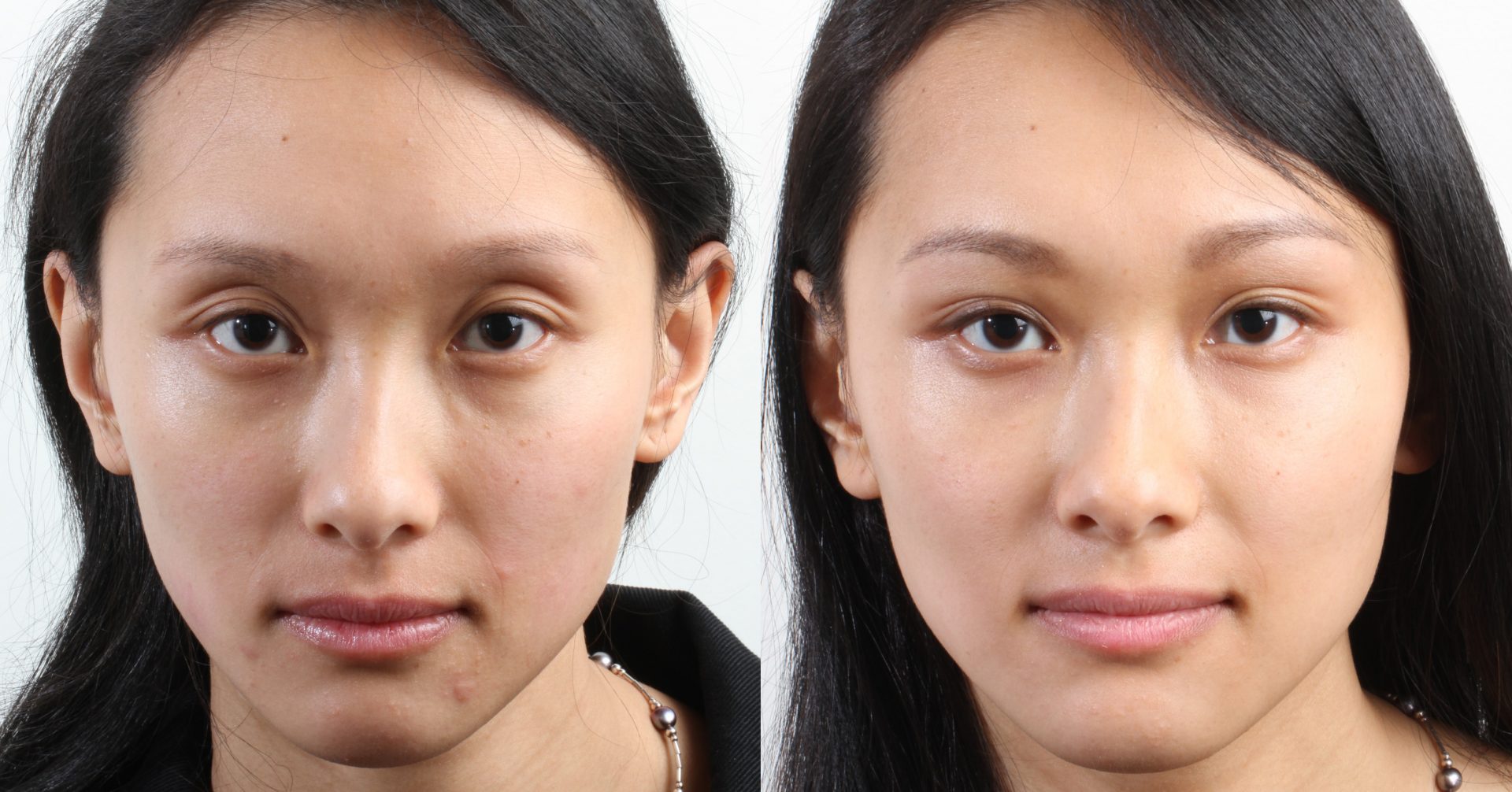 Изменение формы глаза. Филлеры под глаза до и после. Европейцы с эпикантусом. Морщины до после азиатки.