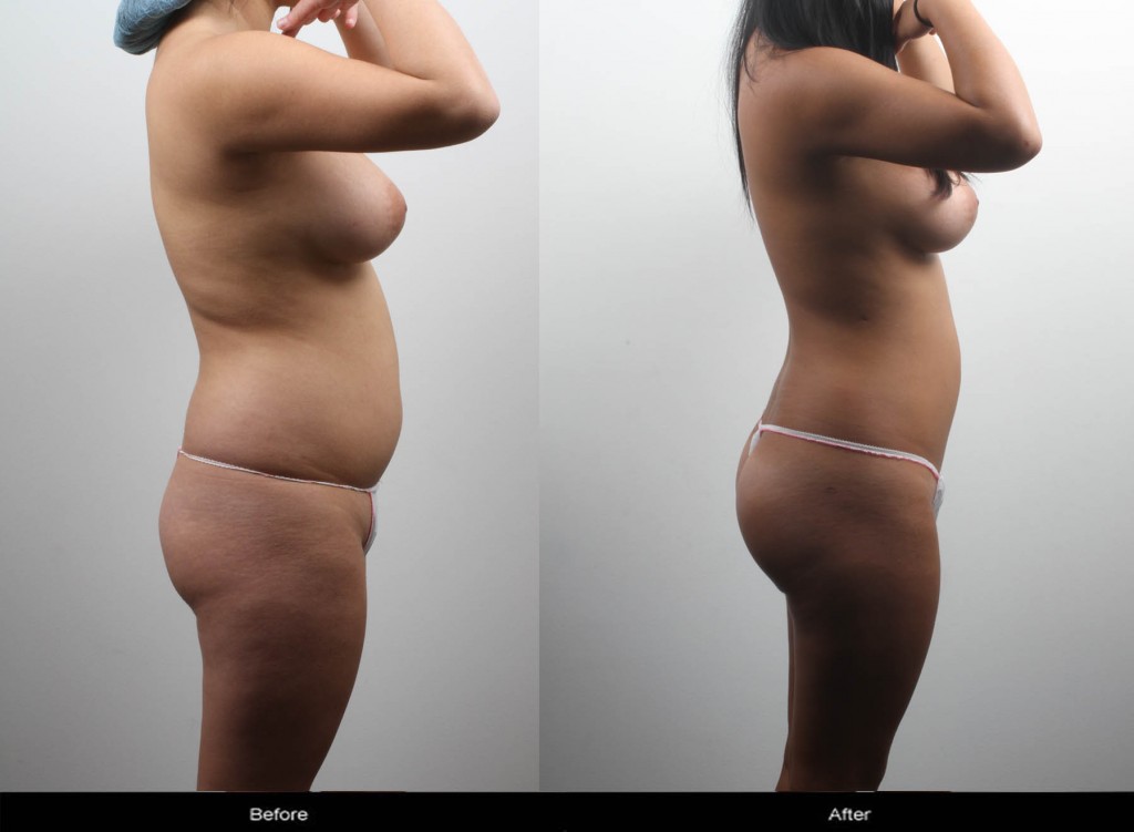 liposuction brazilian butt lift