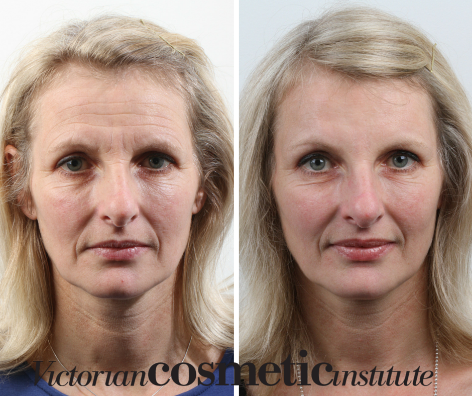 dermal fillers Frown and forehead before and after (1)