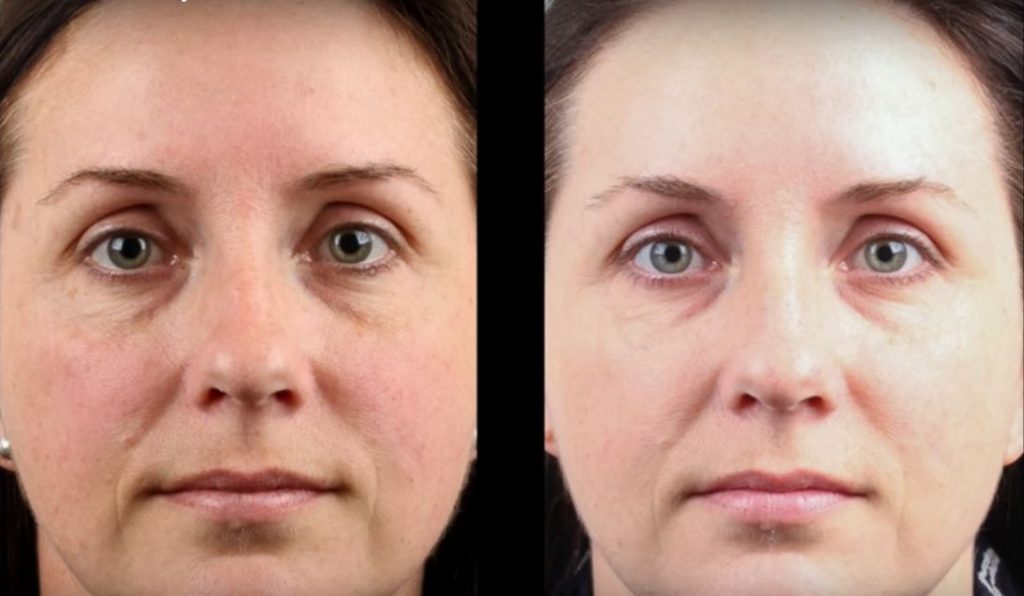 How Freckle Removal Treatments Can Enhance Your Natural Appearance