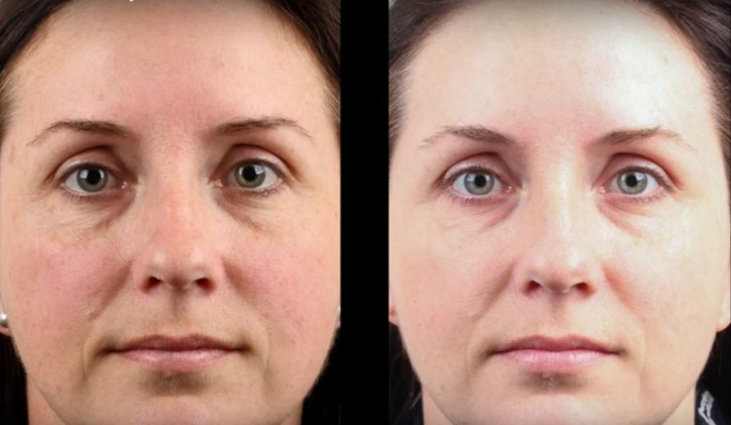 How Freckle Removal Treatments Can Enhance Your Natural Appearance 