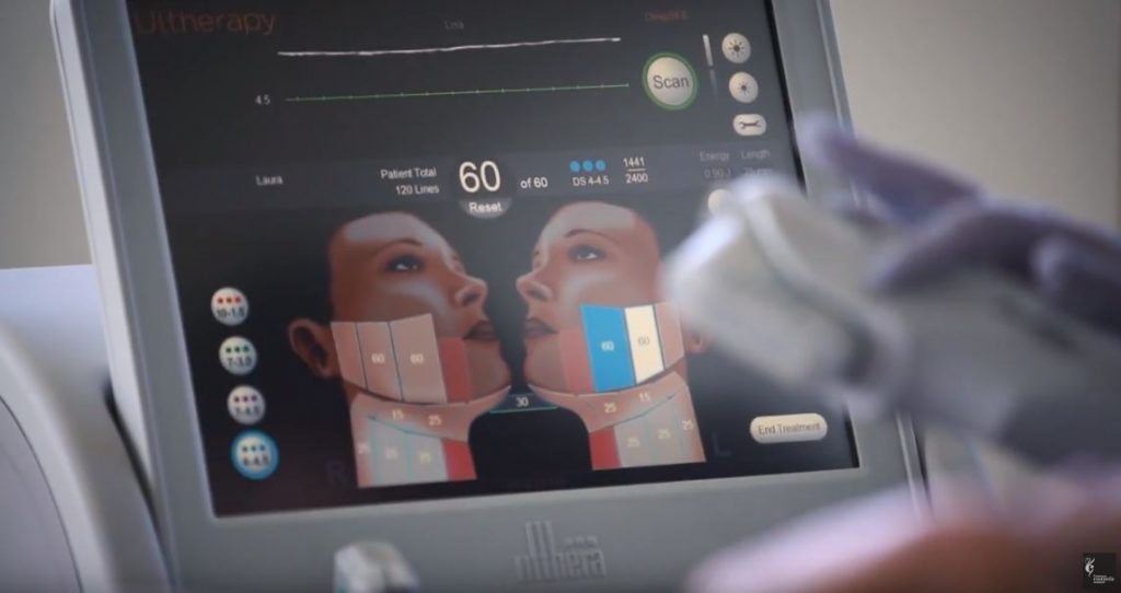 Ulthera Procedure Display Screen