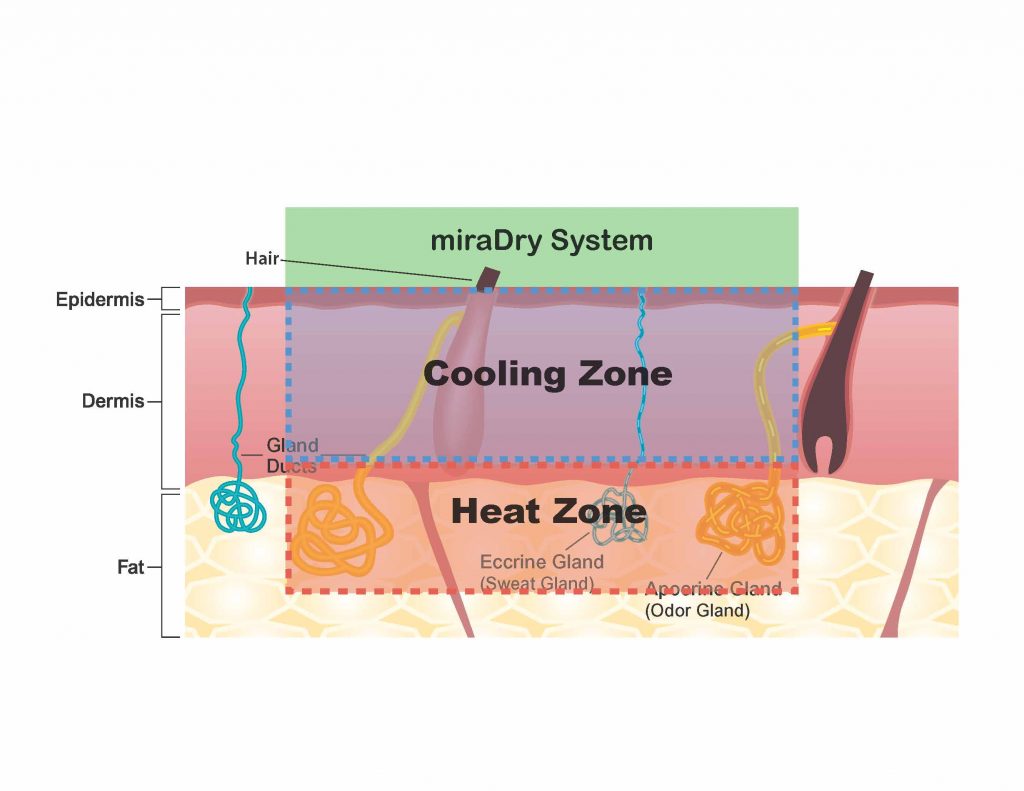 miradry system diagram