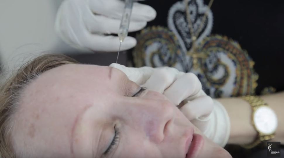 Anti-wrinkle injections with needle