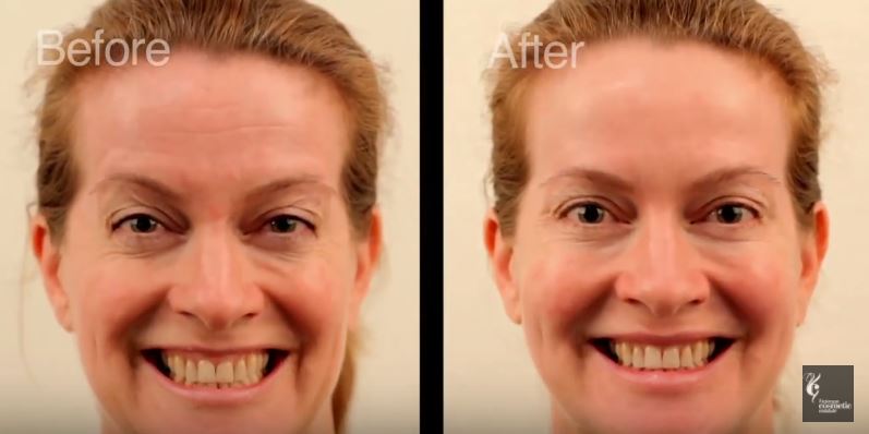 Facial rejuvenation before and after