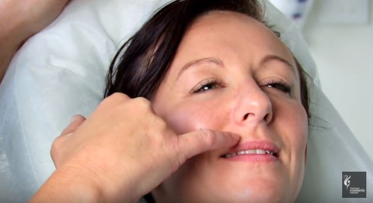 Upper lip wrinkle treatment