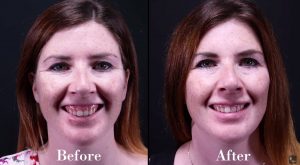 gummy smile before after botox