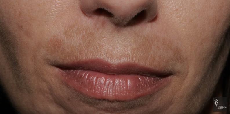 Melasma upper lip