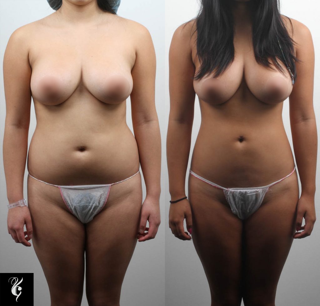 liposuction melbourne