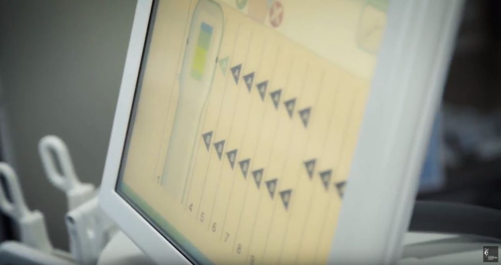 Fed up with excessive sweating? miraDry can treat underarm sweating