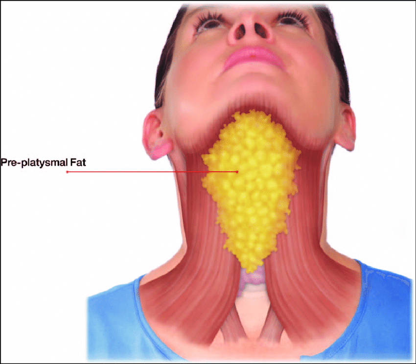 Anterior view of the preplatysmal