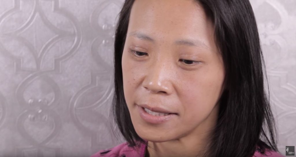 Asian freckle laser removal patient