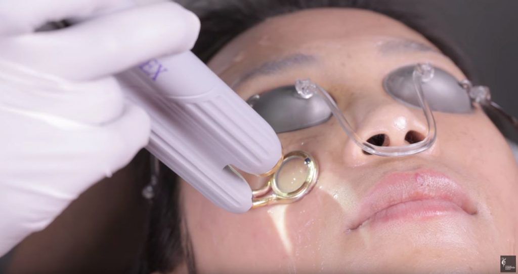 Asian freckle laser treatment procedure