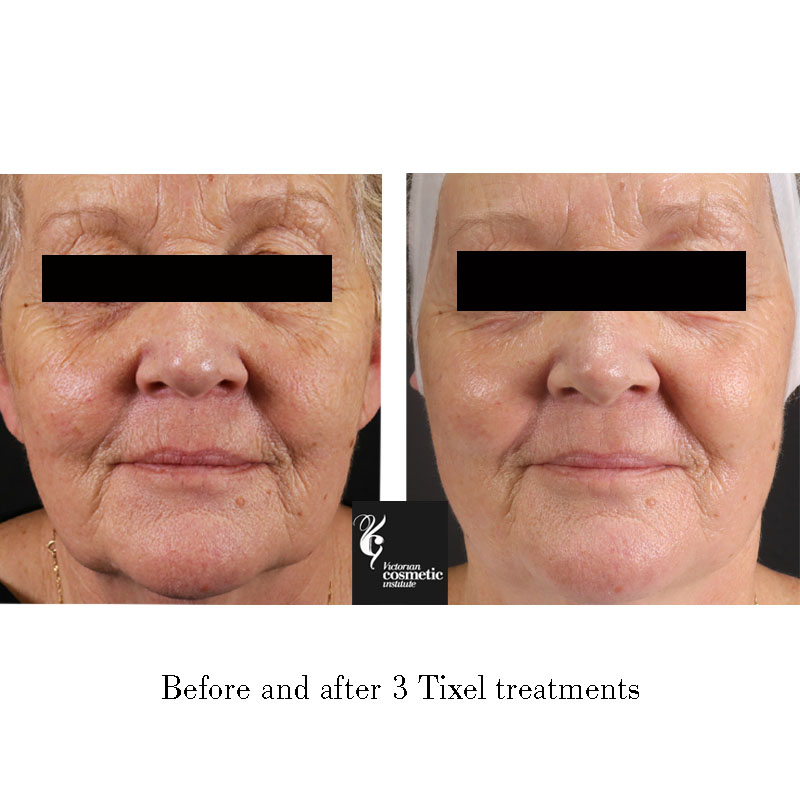tixel treatment full face skin before and after