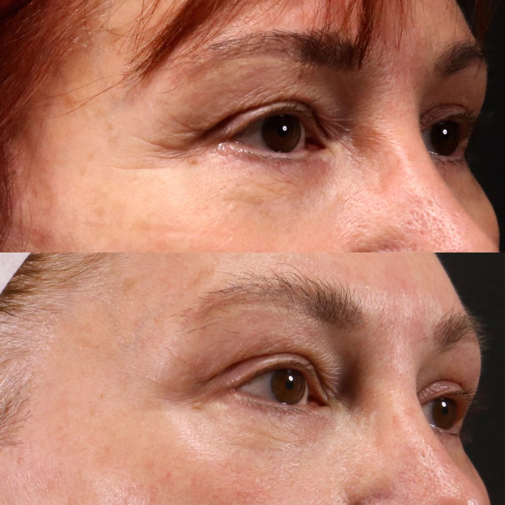 tixel treatment eyes before and after